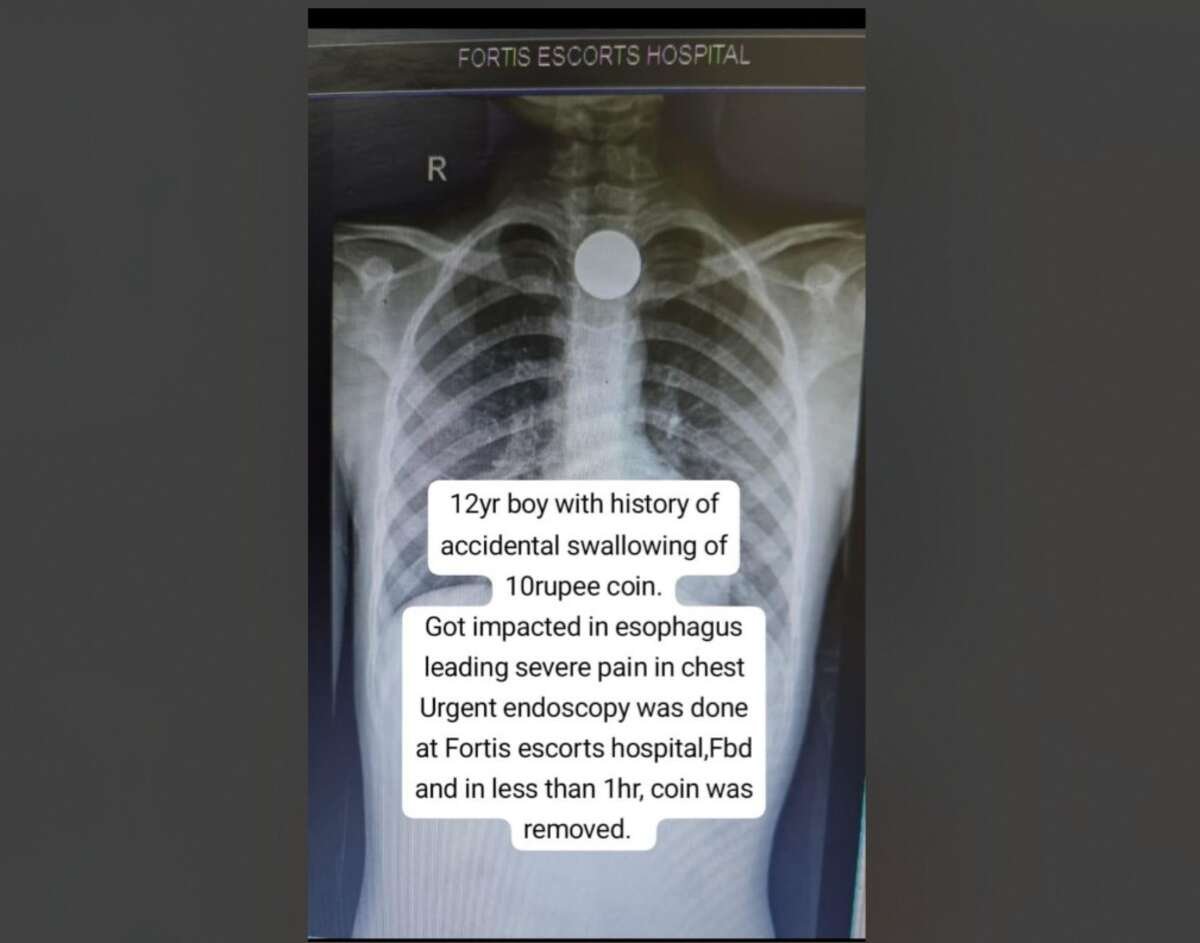 Doctors at Fortis Escorts Faridabad Safely Remove ₹10 Coin Lodged in 12‑Year‑Old’s Food Pipe